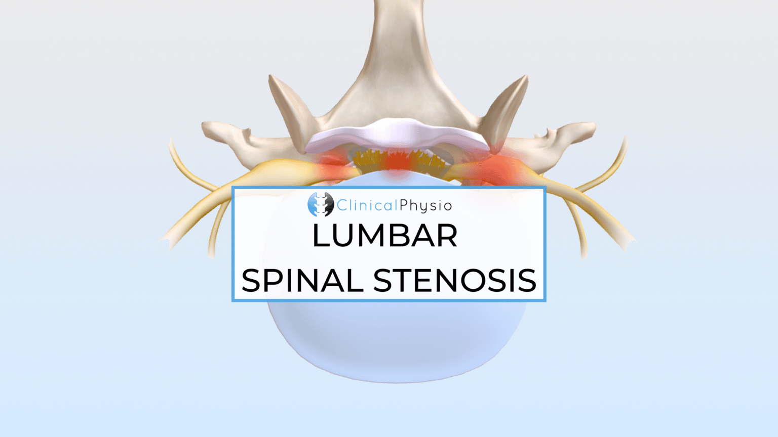 Lumbar Spinal Stenosis – Clinical Physio Membership