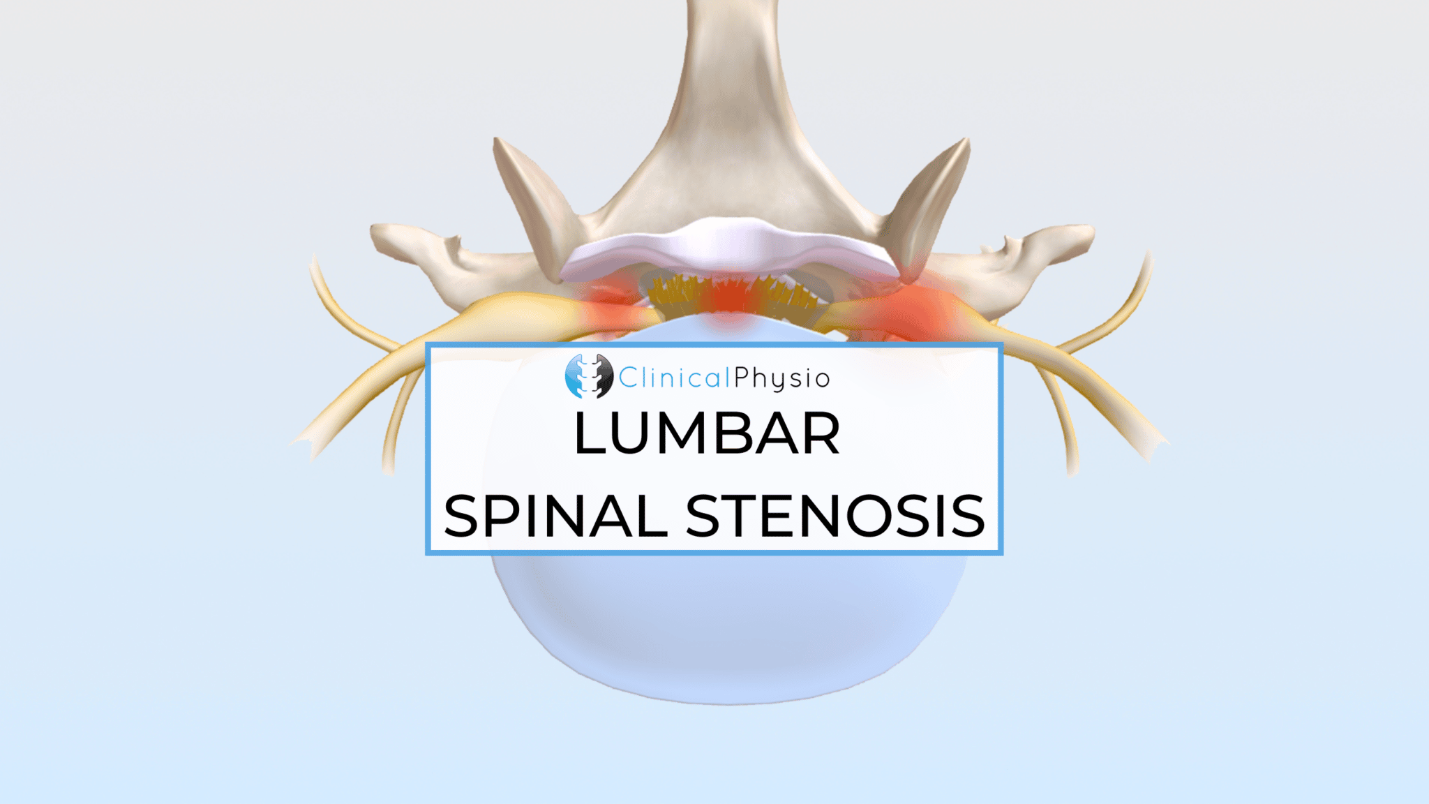Lumbar Spinal Stenosis – Clinical Physio Membership